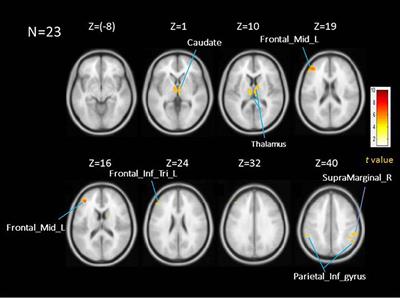 Cortical and Subcortical Neural Correlates for Respiratory Sensation in Response to Transient Inspiratory Occlusions in Humans